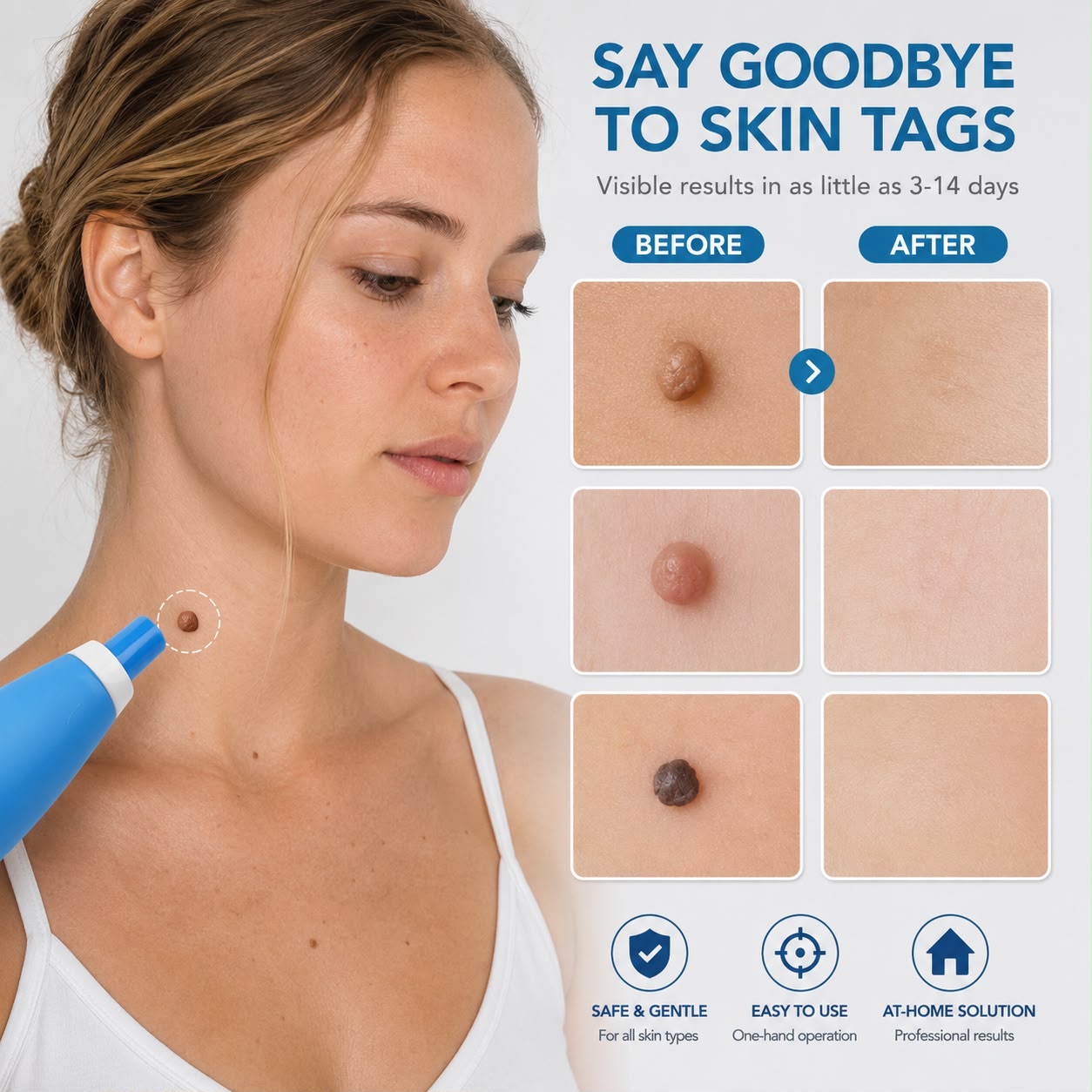 Auraex Gentle Skin Tag & Wart Remover