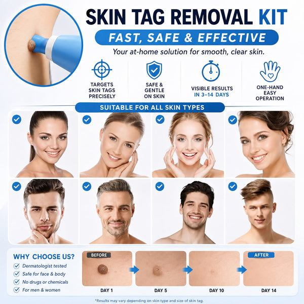 Auraex Gentle Skin Tag & Wart Remover