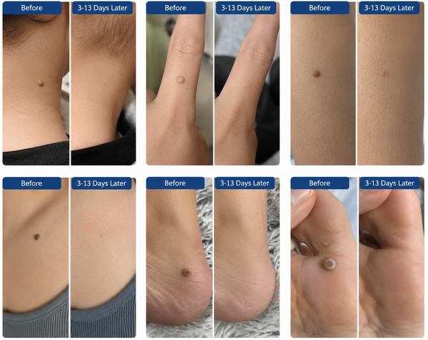 Auraex Gentle Skin Tag & Wart Remover