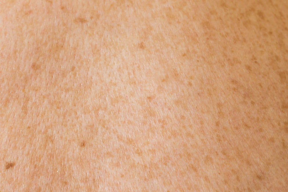 Before - uneven skin texture